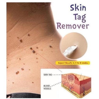 Obat penghilang Kutil Mata Ikan Tahi Lalat Skintag Remover Original