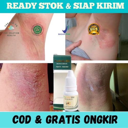 Obat Penghilang Gatal - Gatel Merah Pada Ketiak, Psoriasis, Dermatitis, Obat Ketiak Gatal, Ketiak Ir