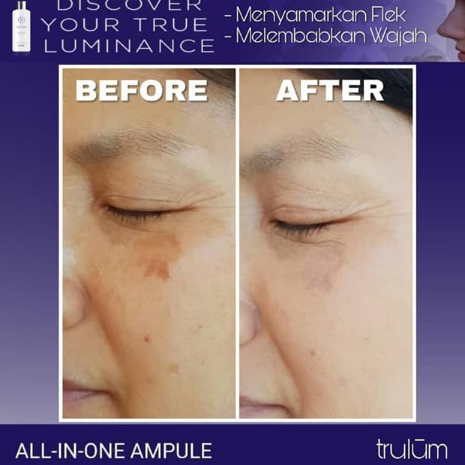 Obati Flek Hitam Membandel | Trulum 5ml