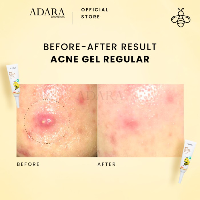 ADARA - Bee Clear Acne Gel Original BPOM