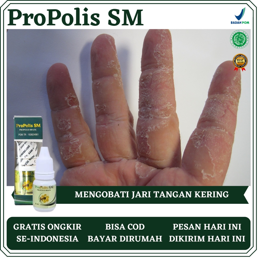 Obat Jari Tangan Kering, Obat Jari Tangan Pecah Pecah, Obat jari Tangan Mengelupas, Obat Telapak Tan