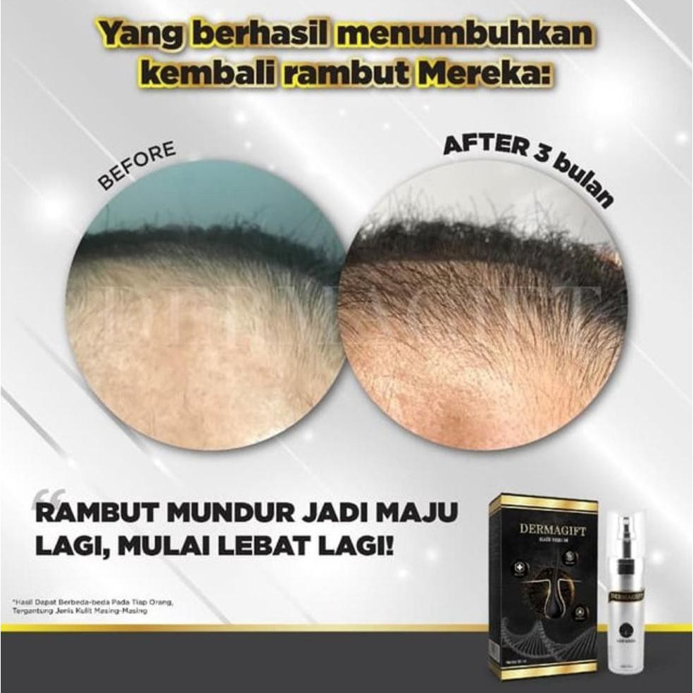 LJH Penumbuh Rambut Botak AMPUH & MANJUR Best Seller - Obat Penumbuh Rambut AMPUH