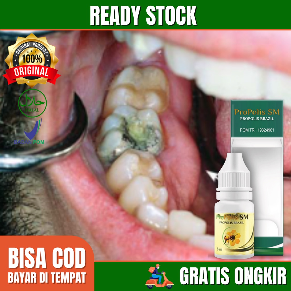 Obat Gusi Bengkak Pereda Penghilang Sakit Gigi Tambal Obat Sakit Gigi Parah Propolis Sm 100 Asli Shopee Indonesia