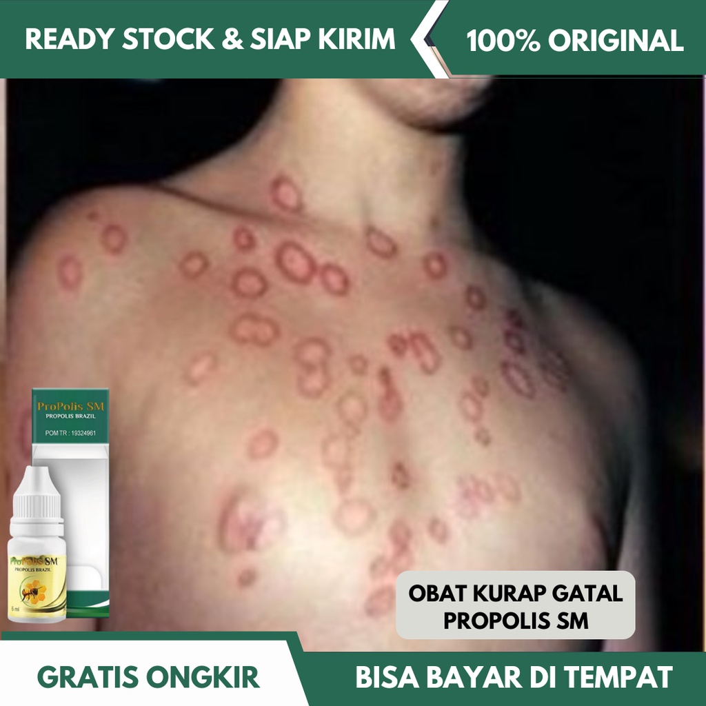 Obat Kurap Gatal - Panu - Budug - Borok Jamur Kulit - Penghilang Bekas Luka Koreng - Jamur Kuku - Ob