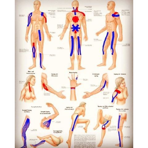 Kinesiology Tapping/Tapping Olahraga