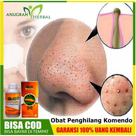 Obat Penghilang Komedo (Mengangkat - Pembersih Komedo Di Hidung, Wajah Untuk Pria Dan Wanita |  QnC 