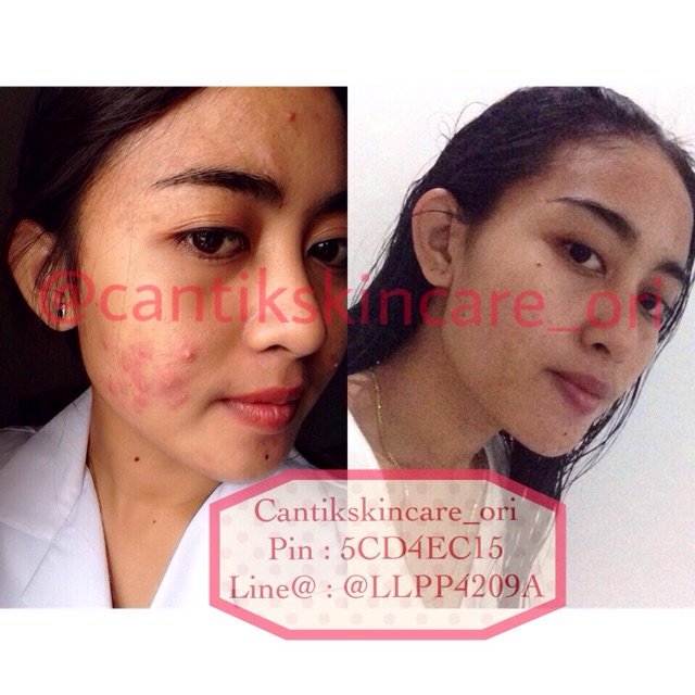 Paket wajah Acne Ms Glow by Cantikskincare ready stock