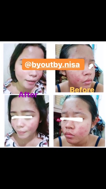 NECK CREAM WAJAH KRIM LEHER HITAM PEMUTIH KOREA HALAL ORI BPOM FARMA AMPUH DOKTER FARMASI SKINCARE GLOWING SKINCARE ORIGINAL TERBAIK DI SHOPEE UNTUK CEWEK COWOK BUMIL BUSUI AMAN ORI SENSITIVE SKIN KULIT SENSITIF AMAN MENCERAHKAN LEHER HITAM KOREAN KOREA