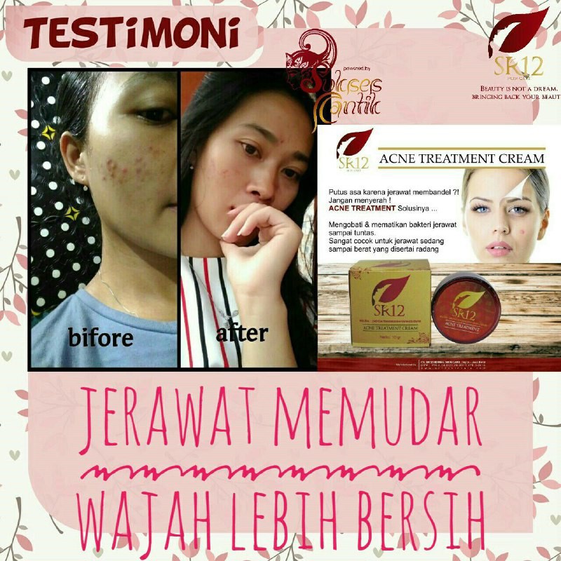 SR12 ACNE TREATMENT CREAM KRIM JERAWAT MERADANG &amp; MEMBANDEL AMPUH HILANGKAN JERAWAT