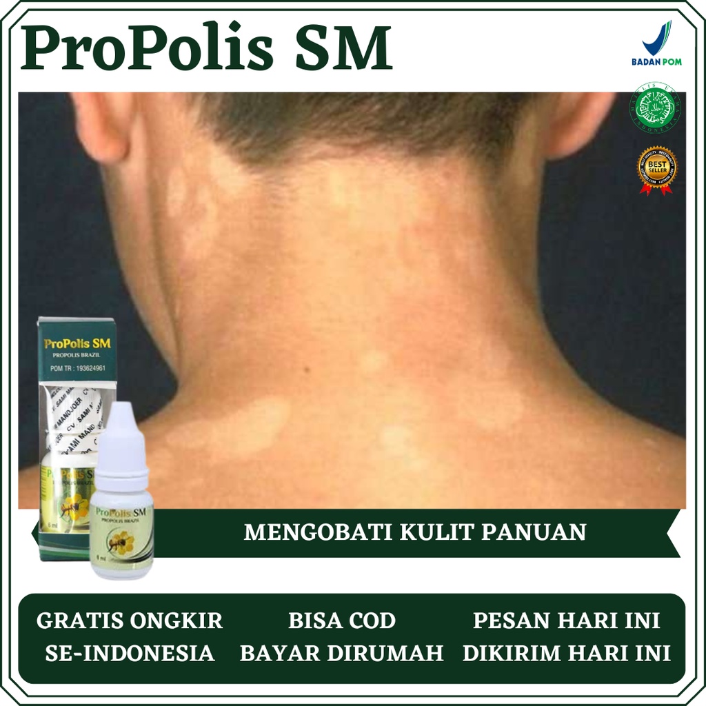 Obat Panu, Obat Panu Wajah, Obat Panu di Leher, Obat Panu di Punggung, Obat Panu Menahun, Obat Hapur