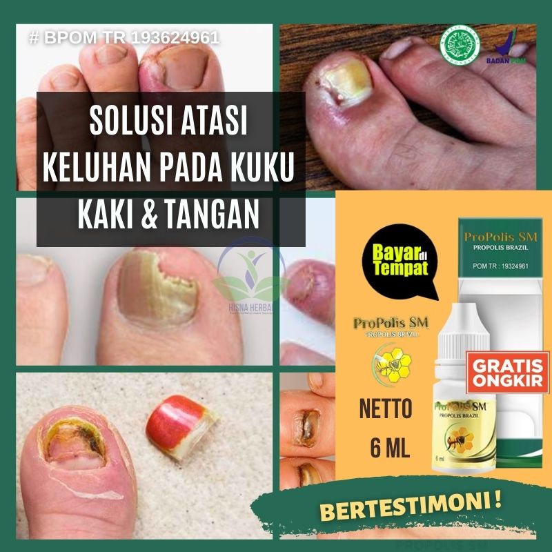 OBAT KUKU KAKI BUSUK, OBAT LUKA KUKU COPOT SENDIRI, OBAT PENGHILANG BAU KUKU KAKI, OBAT ALAMI KUKU J
