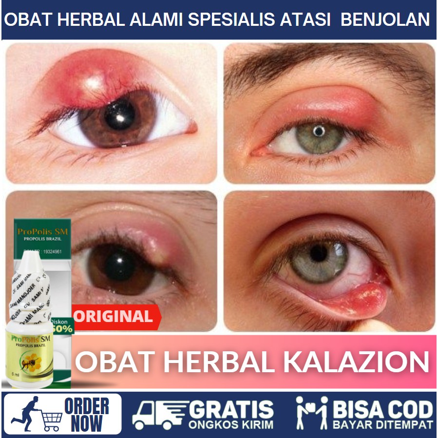 Obat Mata Bintitan Mata Bengkak Wajah Bengkak Sebelah Bintitan Kelopak Mata Bintit Kanan Kiri Shopee Indonesia