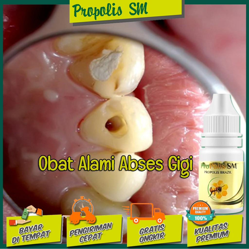 Obat Alami Abses Gigi Yang Terbukti Khasiatnya | Walatra Propolis Brazil SM
