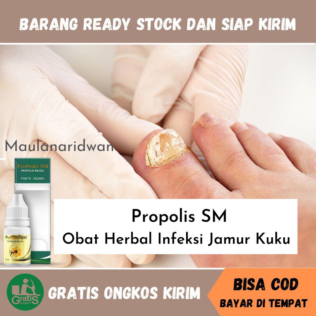 Obat Infeksi Jamur Kuku, Kuku Rusak, Psoriasis Kuku, Obat Herbal Jamur Kuku Di Tangan & Kaki - Propo