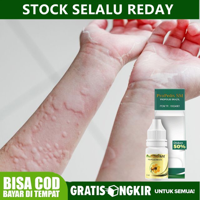 Obat Kaligata , Biduran , Alergi , Alergi Dingin , Gatal Gatal l Herbal Propolis sm 100% Asli