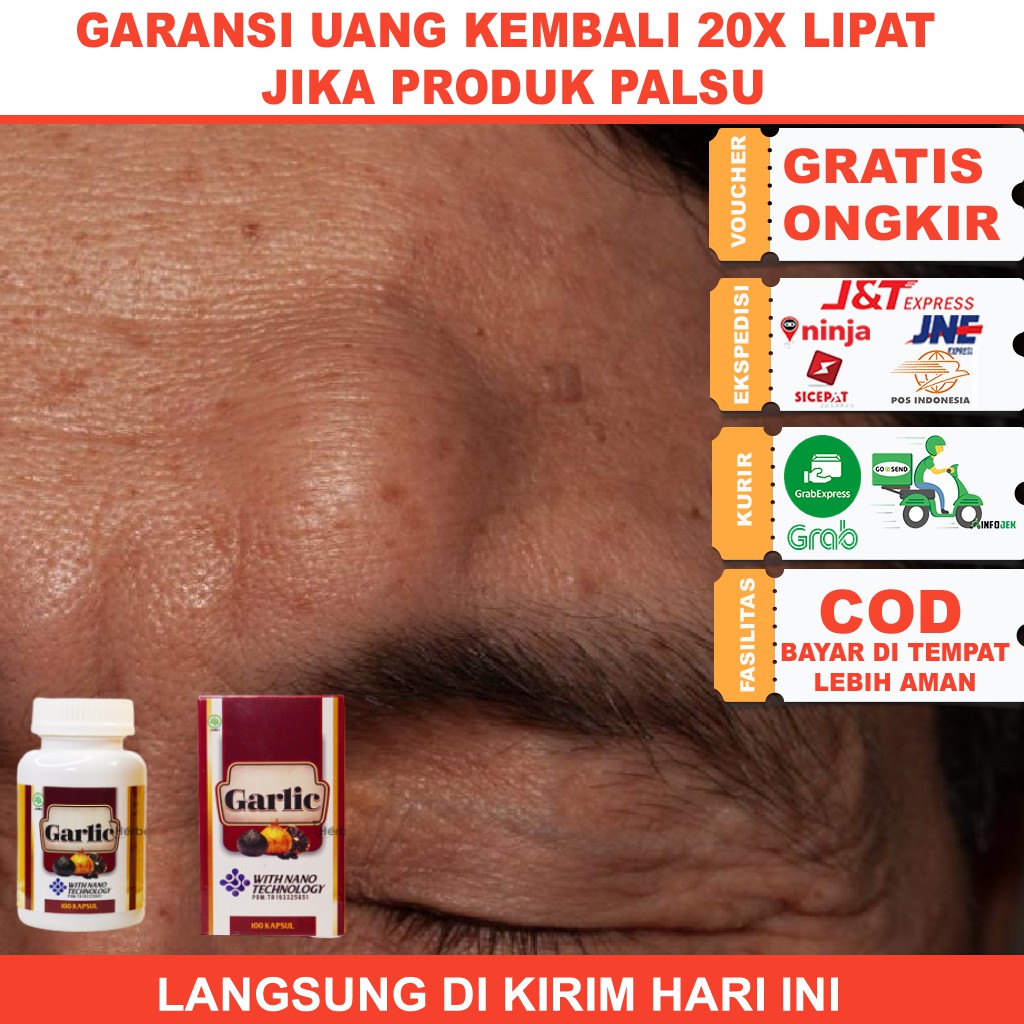 Obat Benjolan di Dahi/ Benjolan di Jidat/ Benjolan Kepala/ BAWANG HITAM LANANG/ BLACK GARLIC