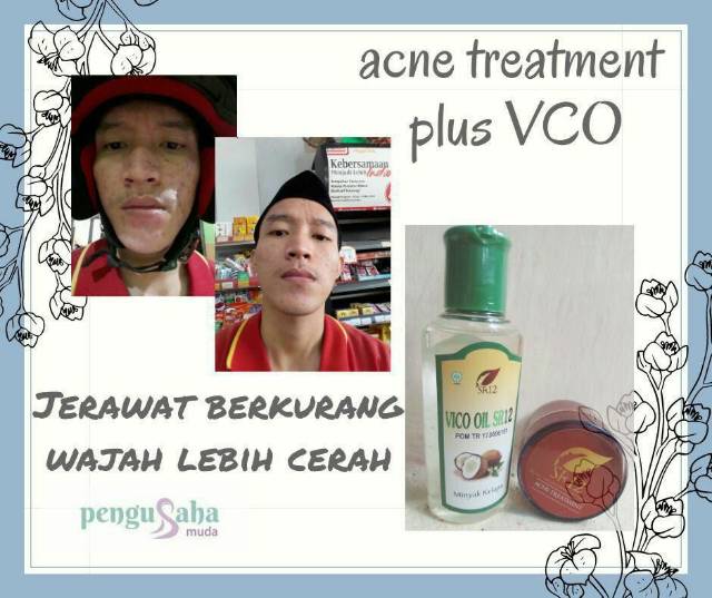 Testimoni Vico Oil Mengatasi Jerawat Komedo Dan Masalah Wajah Lainnya Indonesia