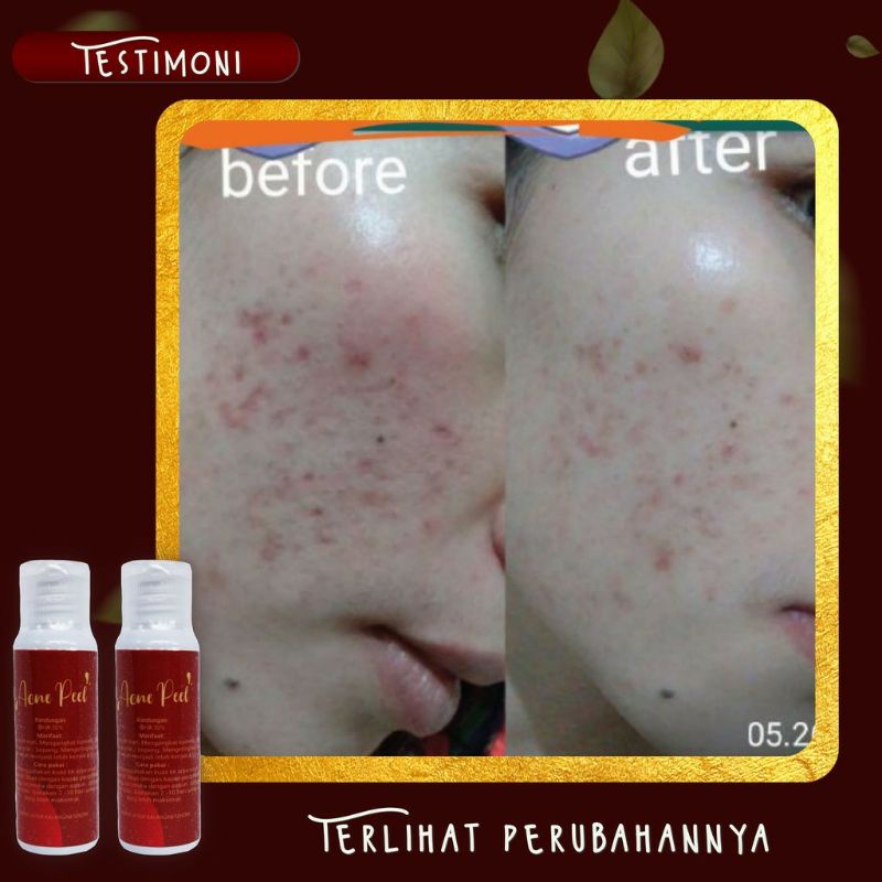 ACNE PEEL SR12 // AMPUHH ATASI BOPENG // AMPUH ATASI JERAWAT PARAH