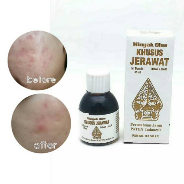 KINDSTORE❤ | Obat Jerawat Wayang ampuh mengatasi jerawat batu