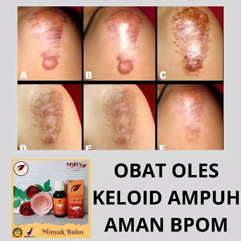Jual OBAT KELOID AMPUH MINYAK BULUS SR12 ASLI Shopee Indonesia