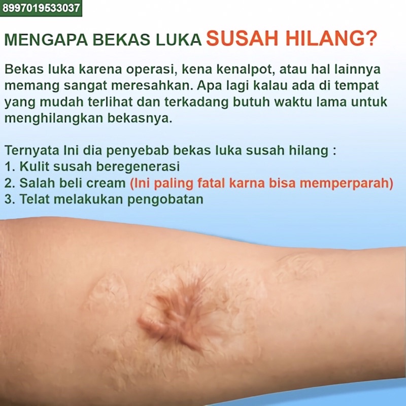 ORIGINAL Meilibahenling Cream Penghilang Bekas Luka Hitam Bopeng Koreng /Jerawat Permanen