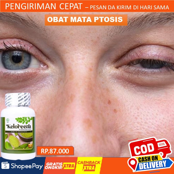 Obat Herbal Mata Ptosis, Kelopak Mata Turun Sebelah, Mata Lelah, Saraf Mata Lemah, Otot Mata Kendur