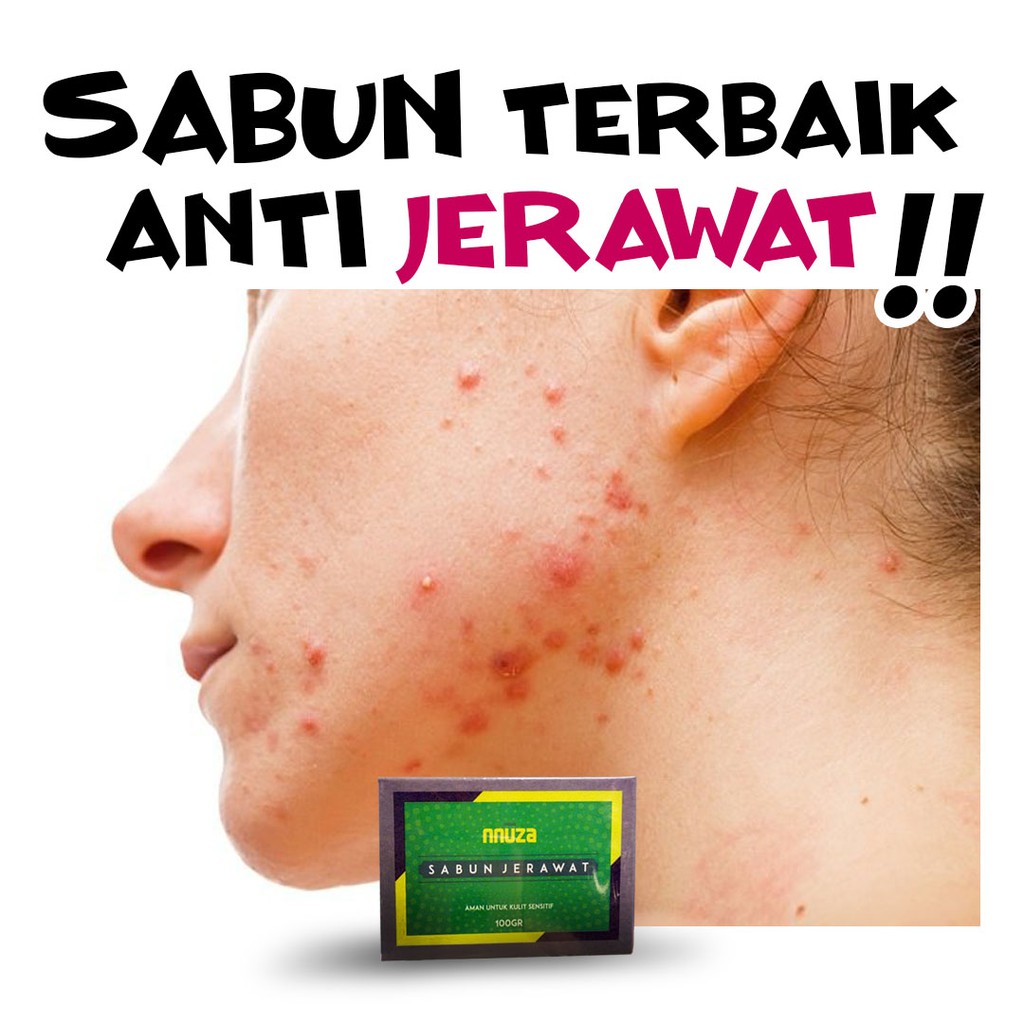 SABUN ANTI ACNE JERAWAT MUKA PUNGGUNG BIANG KERINGAT TERBAIK – NNUZA SOAP