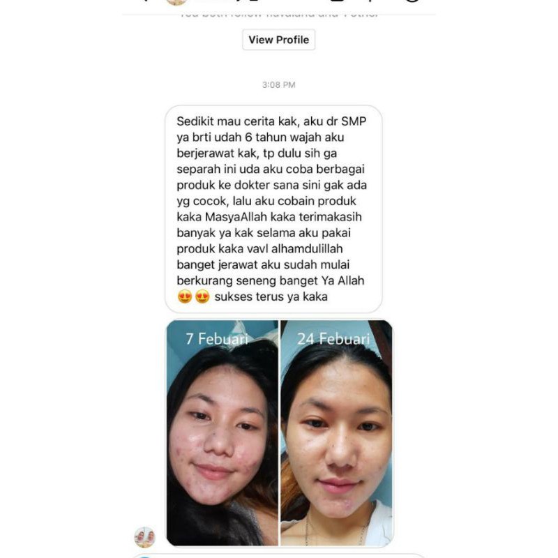 VAVL Paket Beauty Water Vightne Blemish Serum Facial Cleanser Perawatan Jerawat Wajah Kulit Glowing