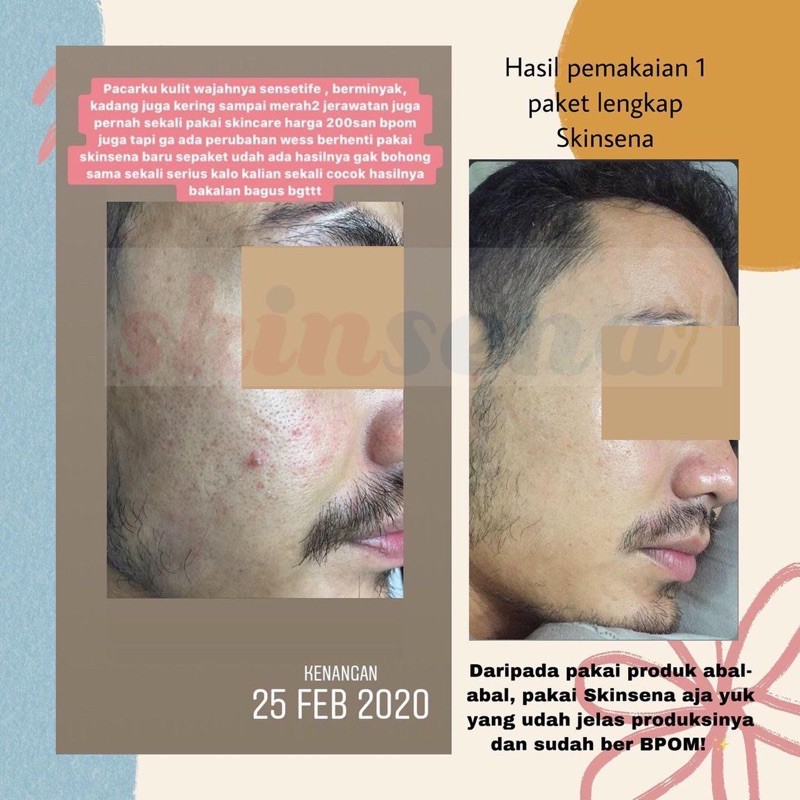 SKINSENA SKINCARE FACE GLOWING, ACNE SERIES, PAKET SKINCARE BPOM