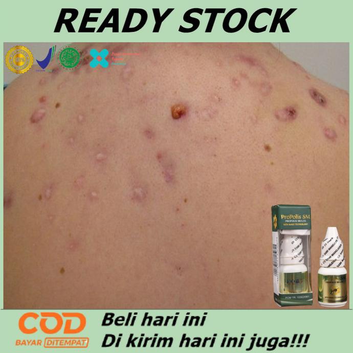 Obat jerawat punggung dan dada, Obat penghilang jerawat punggung