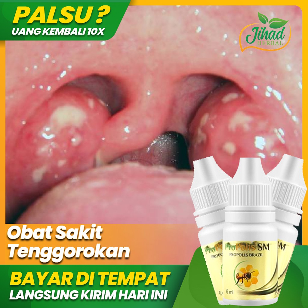 Obat Sakit Tenggorokan, Tenggorokan Gatal, Tenggorokan Kering, Tenggorokan Berlendir PROPOLIS SM