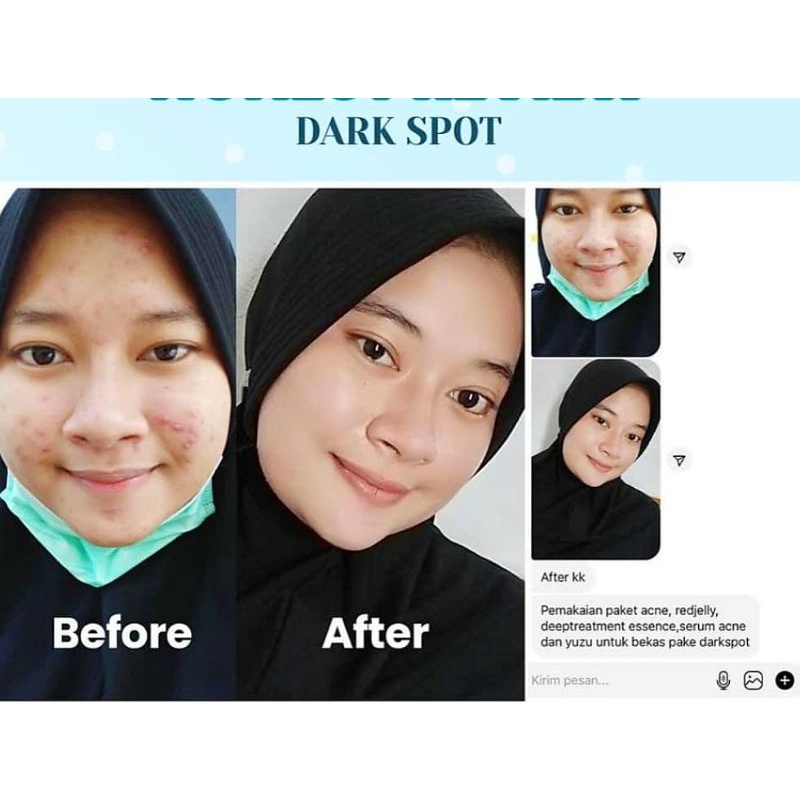 Dark Spot Treatment Serum II Khusus Flek MS GLOW