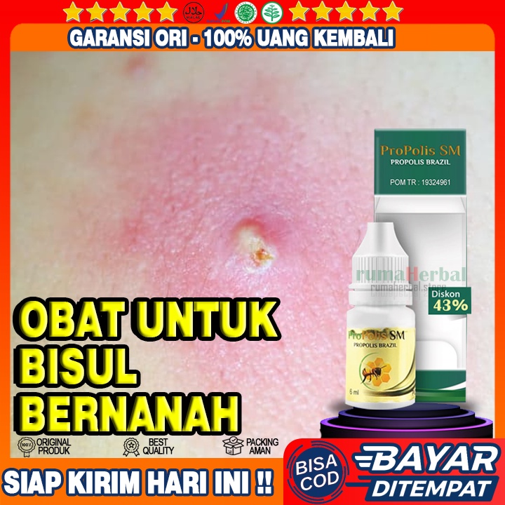 Obat Bisul Bernanah, Bisulan, Bisul Agar Cepat Pecah - Propolis SM ASLI
