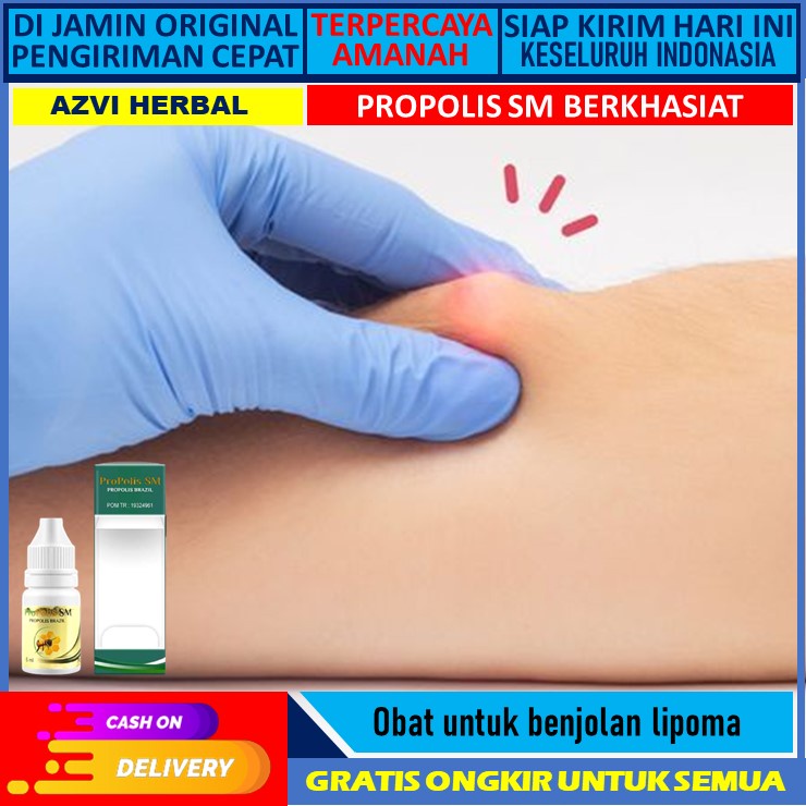 obat lipoma obat benjolan lipoma Obat Benjolan Obat Benjolan Lipoma Obat Lipoma Pengempes Benjolan L