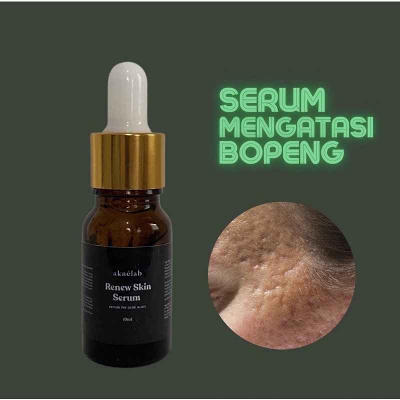 Renew Skin Serum 5ml (perawatan menghilangkan bopeng) Aknèlab