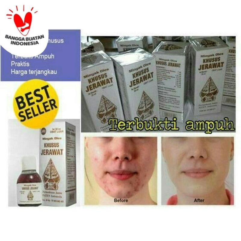 `ღ´ PHINKL `ღ´ Obat minyak jerawat cap wayang herbal organik ijin depkes PIRT