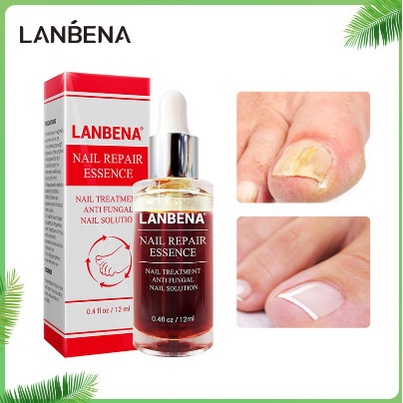 LANBENA NAIL REPAIR ESSENCE OILS SERUM / vitamin kuku anti jamur kapalan nail vitamin fungal