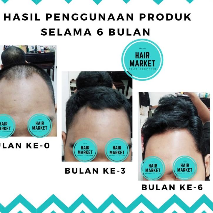 TC Big 3 1 Bulan Solusi Penumbuh Rambut (Minoxidil, Finas, Keto) TC Laris'