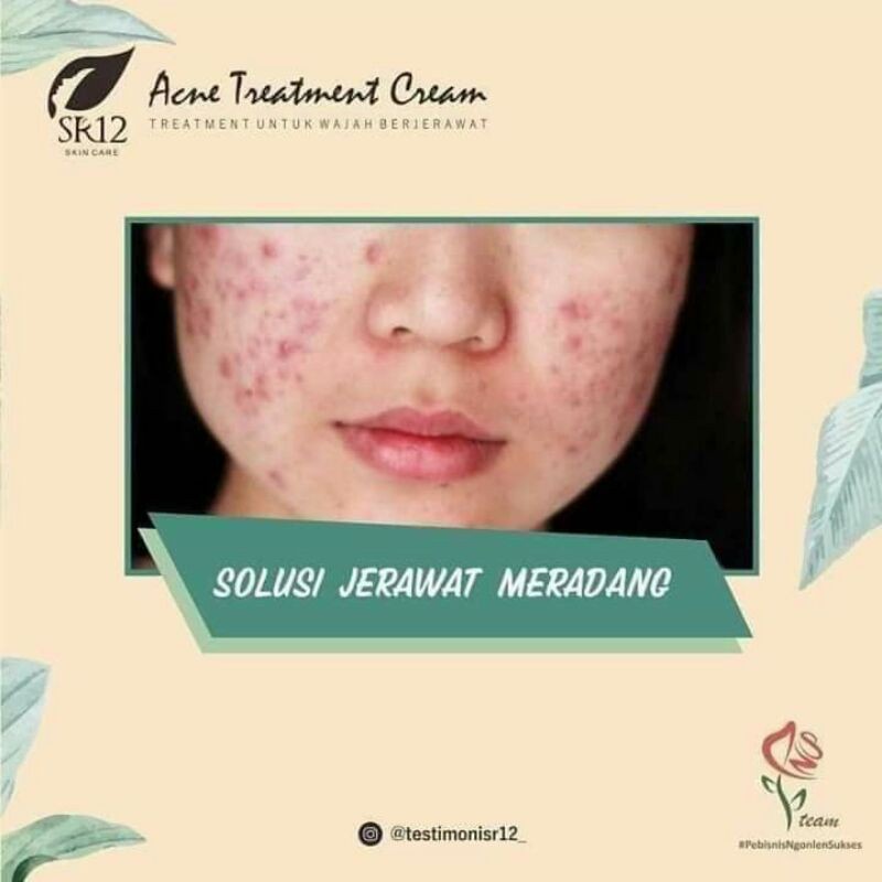 Acne Treatment Cream SR12 Penghilang Noda Bekas Jerawat Luka Stretch Mark