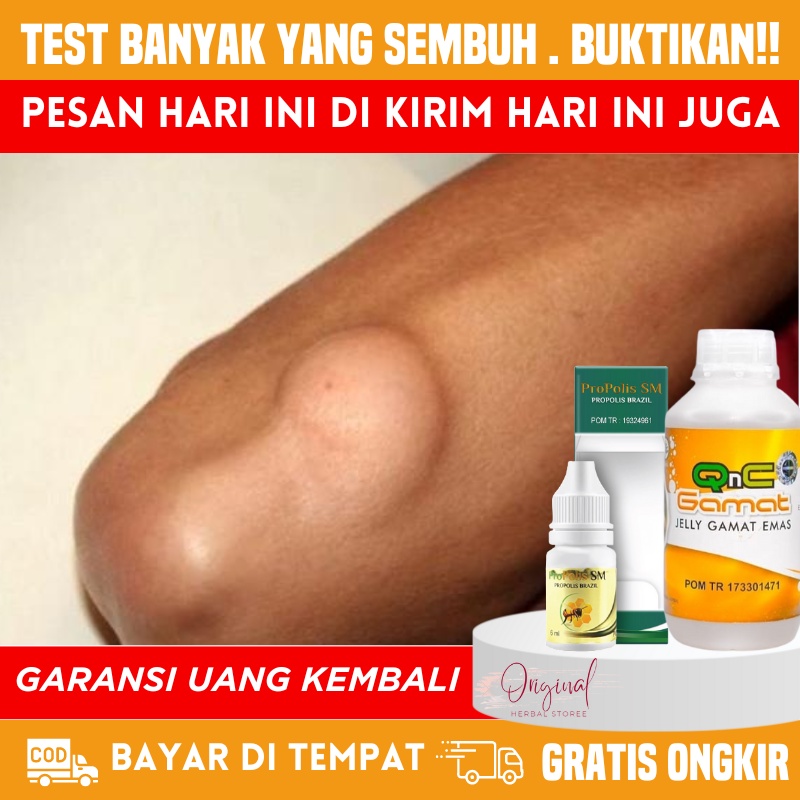 Obat Penghilang Benjolan di Tangan, Penghancur Benjolan tangan, Obat Kista ganglion, Salep benjolan,