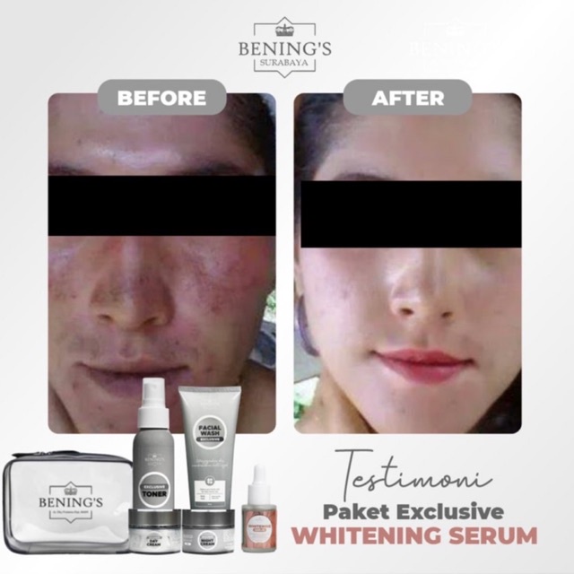 BENING'S PAKET EXCLUSIVE | MENGATASI MASALAH FLEK, MELASMA &amp; MENCERAHKAN