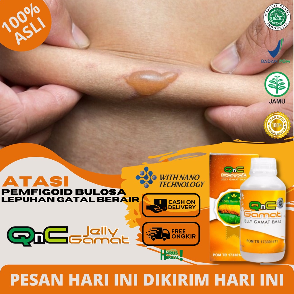 Obat Pemfigoid Bulosa, Lepuhan Berisi Cairan Di Kulit, Lepuhan Gatal, Obat Kulit Gatal Melepuh, Obat