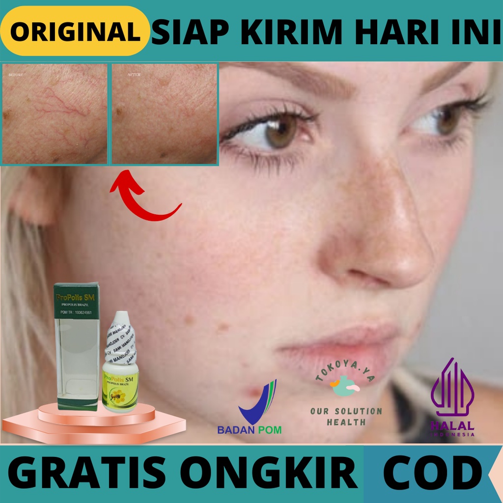 Obat Oles Penghilang Spider Veins BPOM, Obat Herbal Penghilang Urat Halus Di Wajah (spider veins),  