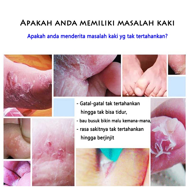 Obat kaki kutu air jamur kuman bakteri kaki bau borok kurap kudis spay penghilang kaki gatal gatal Langdu