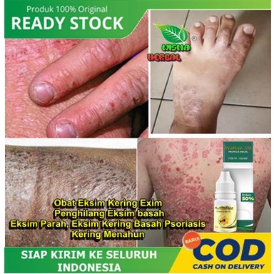 Obat Eksim Kering Exim, Penghilang Eksim basah, Eksim Parah, Eksim Kering Basah Psoriasis, Kering Menahun - Obat Eksim Gatal - Kurap - Panu - Koreng - ProPolis SM Brazil BUKAN Salep OBAT CINA Aman Anak &amp; Dewasa Pria Wanita