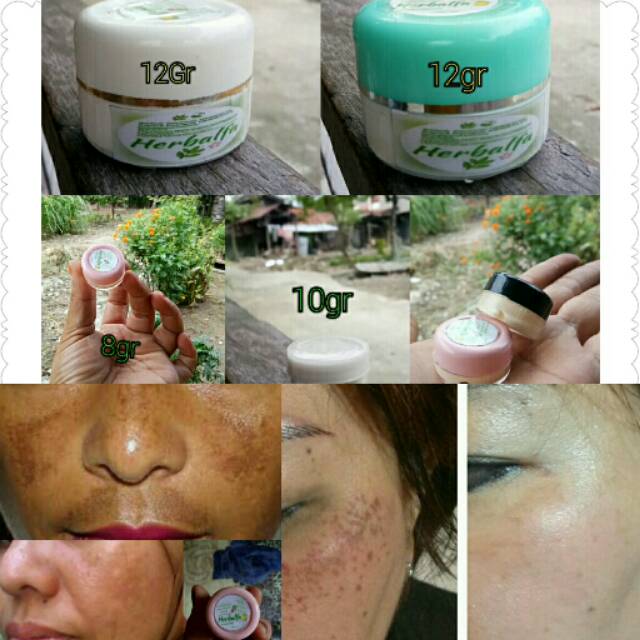 CREAM Penghilang flek hitam diwajah tanpa pengelupasan jg iritas diwajah hanya dlm wkt 1minggu .