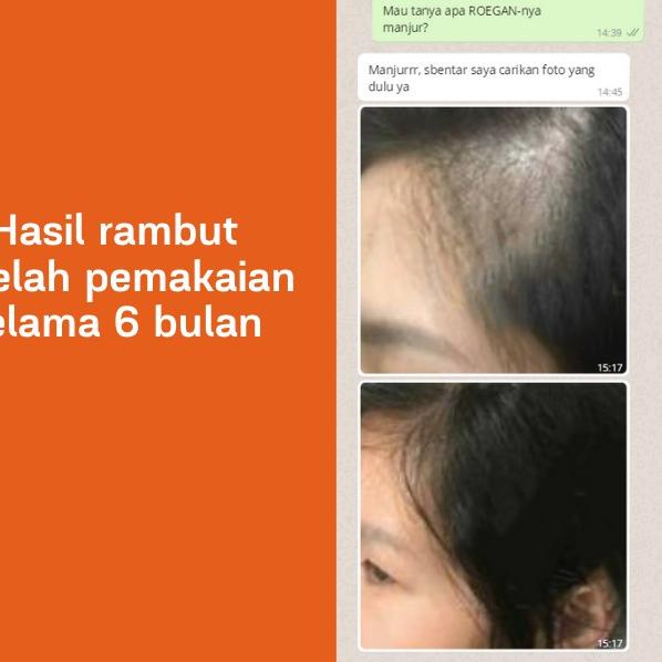 ➯ ROEGAN Minoxidil 2% - Penumbuh Rambut (untuk Botak & Rontok) ۝