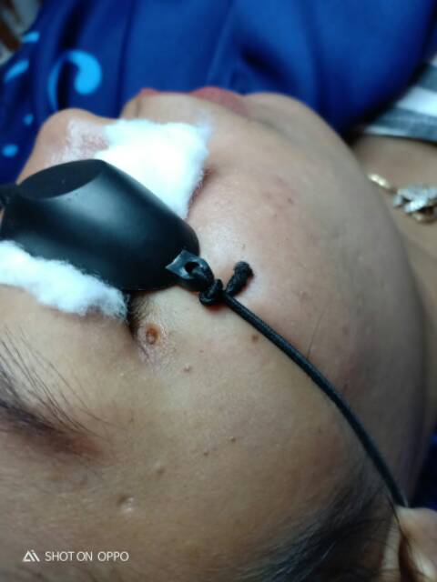 Picosecond alat laser penghilang flek bekas jerawat tato tai lalat kutil black spot mole removal