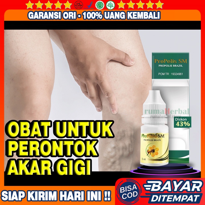 Obat Varius Varises, Untuk Mengobati Varises, Varises Kaki, Varises Kolorektal, Penghilang Varises