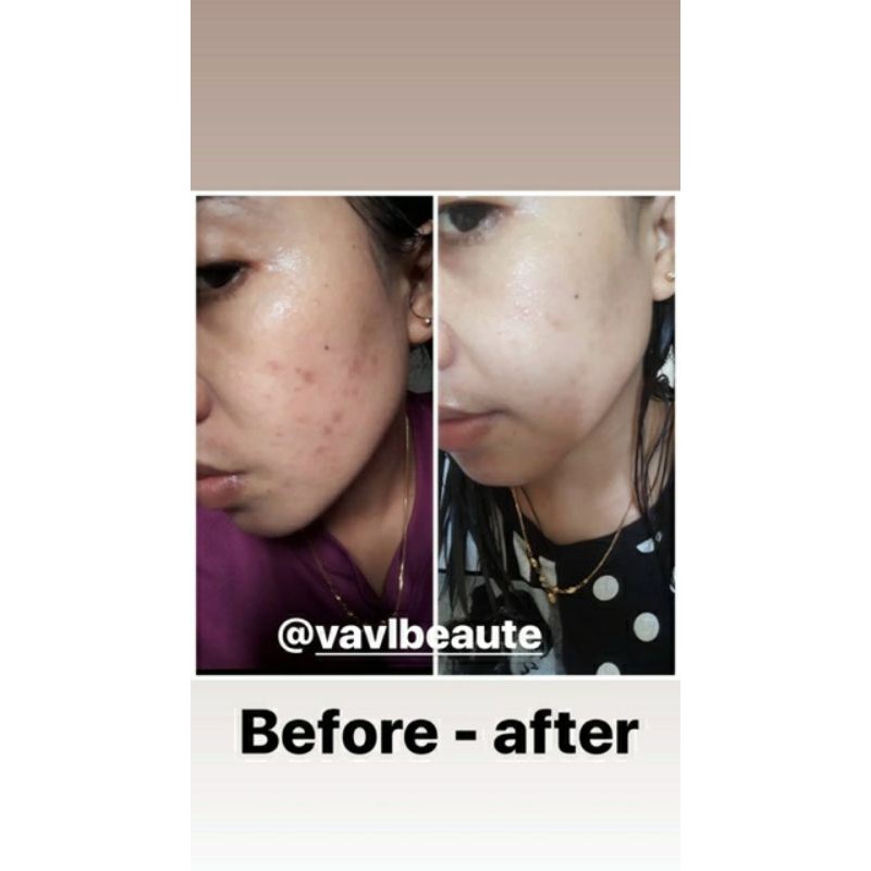 VAVL MASKER ACNE / MASKER ACNE FREE GIFT